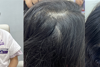 脱发问题严重,皮肤科专家刁庆春也能治