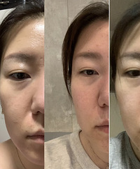 欧洲之星fotona 4d!抗法令纹的神器