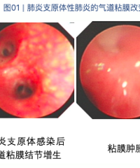 有医院最高峰时一天做了67例洗肺