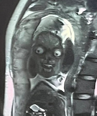 34��+MRI�µ���λ������̫�ɰ��ˣ���ͨ����