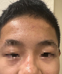 油皮真的太爱长痘痘,没想到做针灸也能治疗!这是做4次的变化