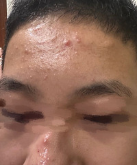 没想到做针灸也能治痘痘,这是做4次的变化