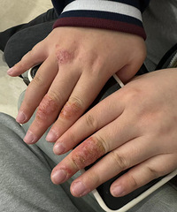 被湿疹困扰了好几个月,看了这个皮肤科医生,5天就好得差不多了