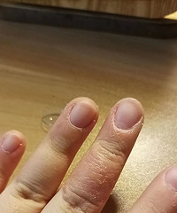 被湿疹困扰好久,看了皮肤科医生,5天就好了