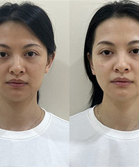 妇幼保健院做了BB光嫩肤,皮肤好透亮