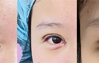 附一院做的双眼皮手术,半个月后就很自然了