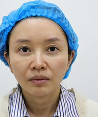 看我半边脸的效果,实打实的消灭了我的法令纹