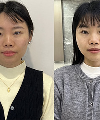 做了能够提升面部肌肉的抗衰神器和小黑瓶水光,状态回到5年前
