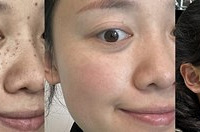 希望所有长斑的女生都能看到,做一次超皮秒真有效