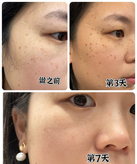 做超皮秒7天后,我脸上的斑真的淡了好多!同事都说效果好好
