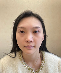 太神奇了!做完之后,黑眼圈是真的越来越淡了