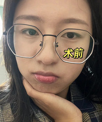 眼皮越来越松,做了双眼皮手术,眼睛变大后看着都显年轻