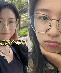 做了双眼皮,眼镜再也封印不了我的颜值