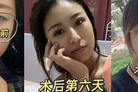 做双眼皮手术2个半月,自然得都看不出我动过刀