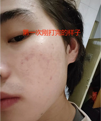 青春期留下的痘印,医生都推荐我做光子嫩肤