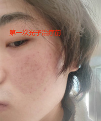 青春期留下的痘印太多了!医生都推荐我做光子嫩肤,确实不错