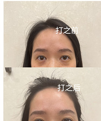 说实话,淡化黑眼圈用这个方法是真的很明显!过年前搞一次