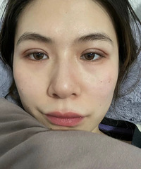 我来说说做双眼皮手术的真实感受,前几天睁眼都累,但真的好自然