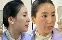 热玛吉真的是抗衰神器啊!即刻变化惊呆我