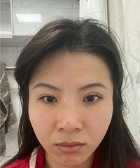 受不了我的菱形脸!做了填充之后,脸饱满了,看起来年轻很多岁