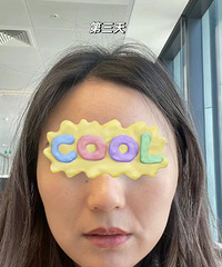看看我6天瘦脸后的变化吧,面部线条更流畅了