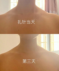 这个瘦肩的方法,我认为特别有效!来看看11天后的变化