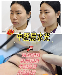 半年5次光子嫩肤+中胚疗法,痤疮终于没了