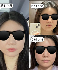 我要夸夸超声炮,不仅脸瘦了,下颌线都有了