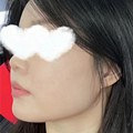 超声炮的瘦脸效果真棒