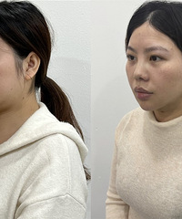 这个才是真正的瘦脸王者吧!这效果,好像减肥瘦了10多斤!