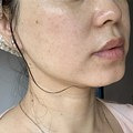 祛斑10天后的脸