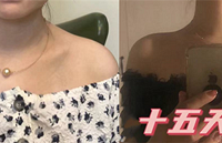 瘦肩25天后,这个夏天穿吊带稳了