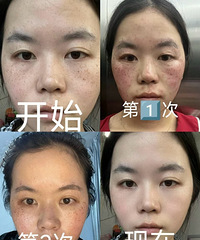 25岁做两次祛斑,被家里人说浪费钱!你觉得效果怎么样