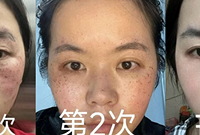 做了两次祛斑,被家里人说浪费钱,你觉得呢