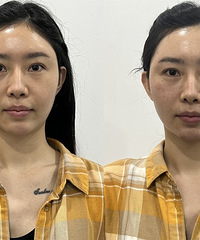 敏感肌也真能修复!这些治疗做完一次,不仅祛红了,还毛孔细腻了