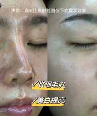 敏感肌也真能修复!这些治疗做完一次,不仅祛红了,还毛孔细腻了