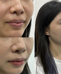敏感肌也是能修复的,治疗一次大变化