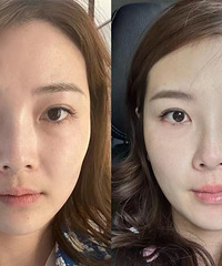 如果预算不高,又想抗衰,那我推荐你做超声炮!收紧淡纹效果真好
