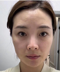 如果预算不高,又想抗衰的话,超声炮确实效果好