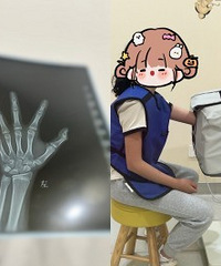 给娃查骨龄,发现娃早发育了