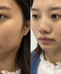 �����շ�������Ƴ����ӣ��ܵ�����Ѫ˿��ϸ��ë�ף���ɫ����3��