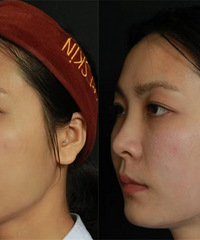 垮脸必看!如果每年只做一次抗衰,那就超声炮!提升紧致效果真好