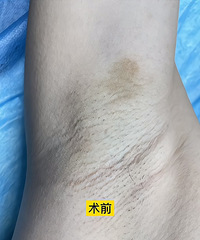 伴随我十年的腋臭消失了!终于可以穿吊带了...