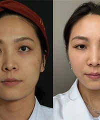 如果每年只做一次抗衰,那就做这个