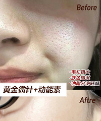 黄金微针术后真实反馈来了,附前后皮肤对比,毛孔都快看不到了