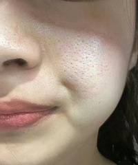 黄金微针术后真实反馈来了,附前后皮肤对比,毛孔都快看不到了