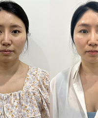 眼周抗衰太有必要!提升眉骨,抚平泪沟,淡化黑眼圈,就能更年轻