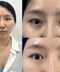眼周抗衰太有必要,黑眼圈都快没了