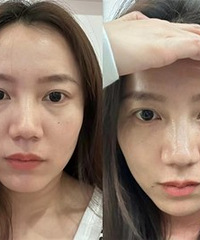 没有了泪沟之后,感觉自己精神多了