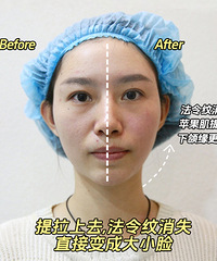 这有个法令纹消失术,你想知道吗?看看我只做了半边脸的真实效果